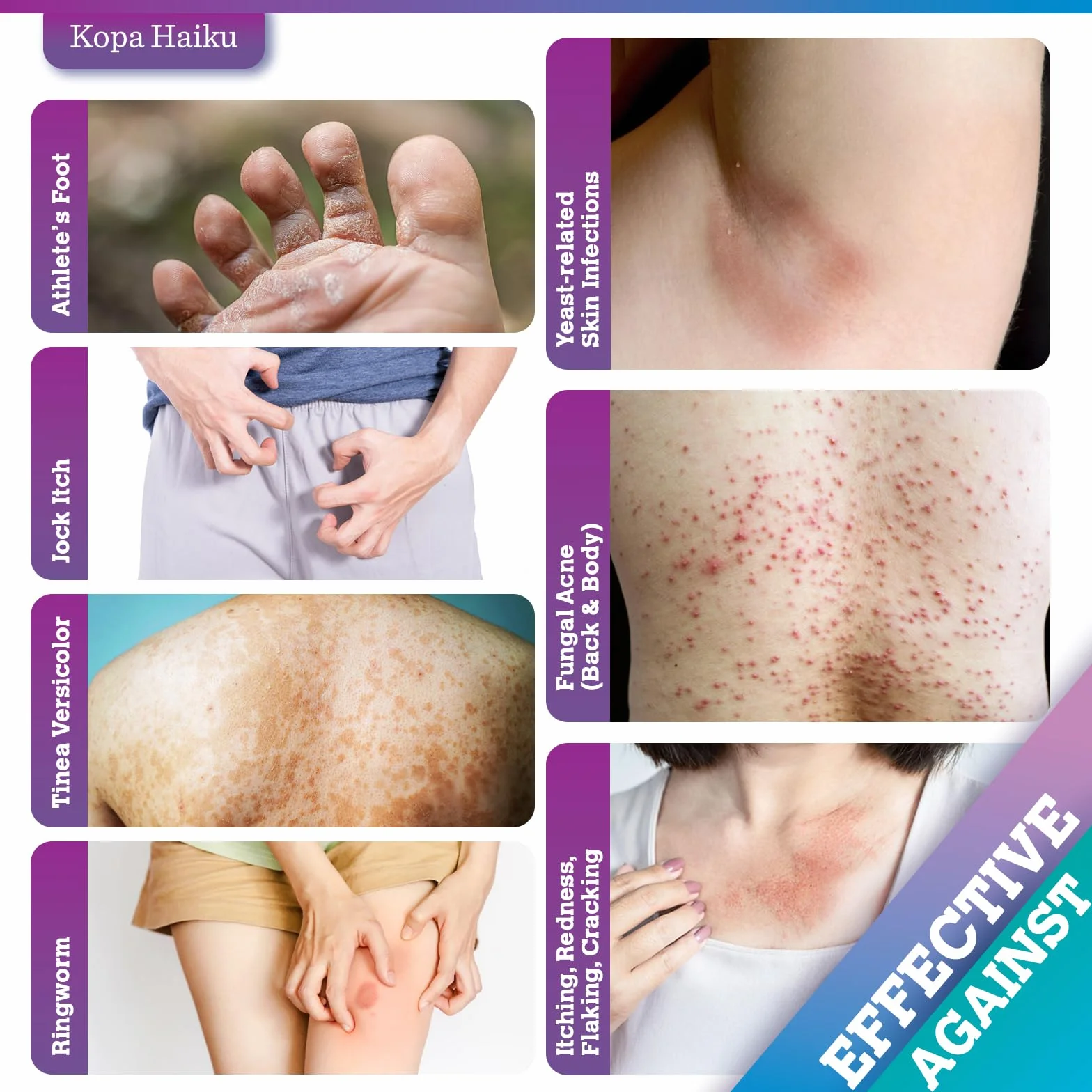 Crema Antimicotica Hongos Pies Atleta: Crema para tiña inguinal, Cuidado Tópico para Pies, Ingles, Axilas y Pliegues Cutáneos
