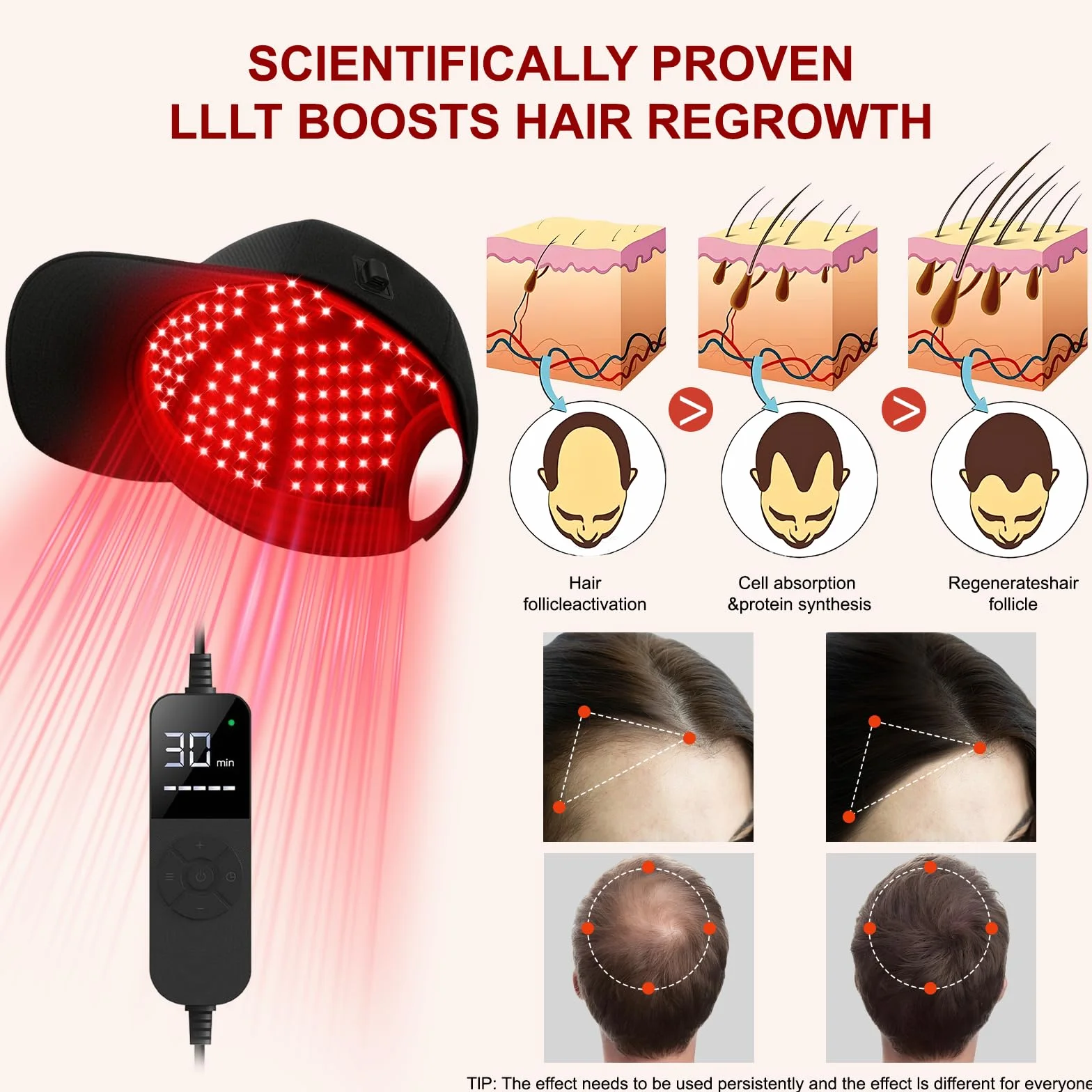 Gorra láser LLLT para crecimiento del cabello – Luz roja e infrarroja 660/850/940 nm, 5 niveles, temporizador