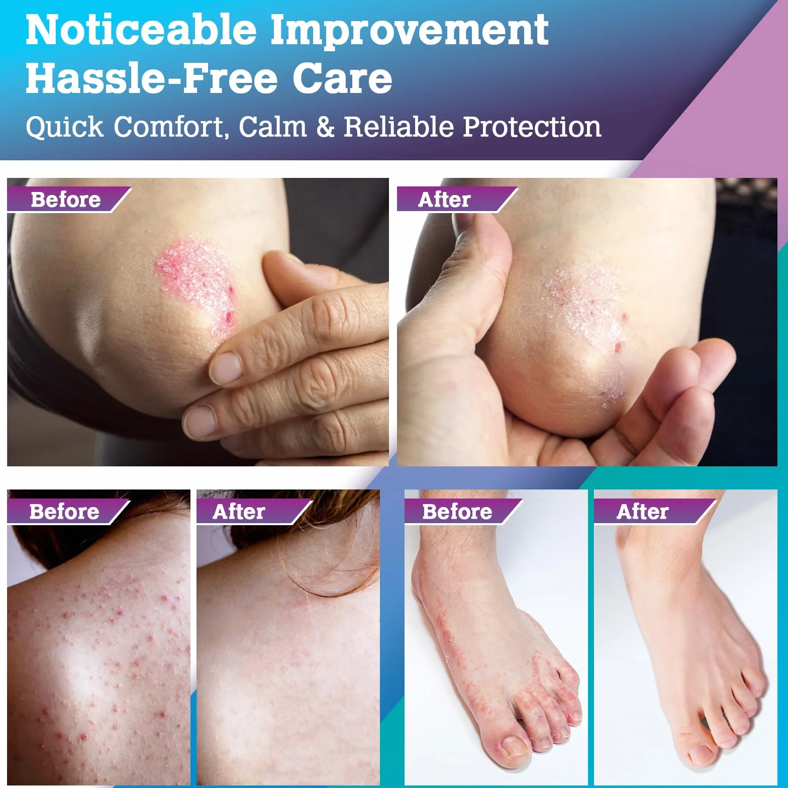Crema Antimicotica Hongos Pies Atleta: Crema para tiña inguinal, Cuidado Tópico para Pies, Ingles, Axilas y Pliegues Cutáneos