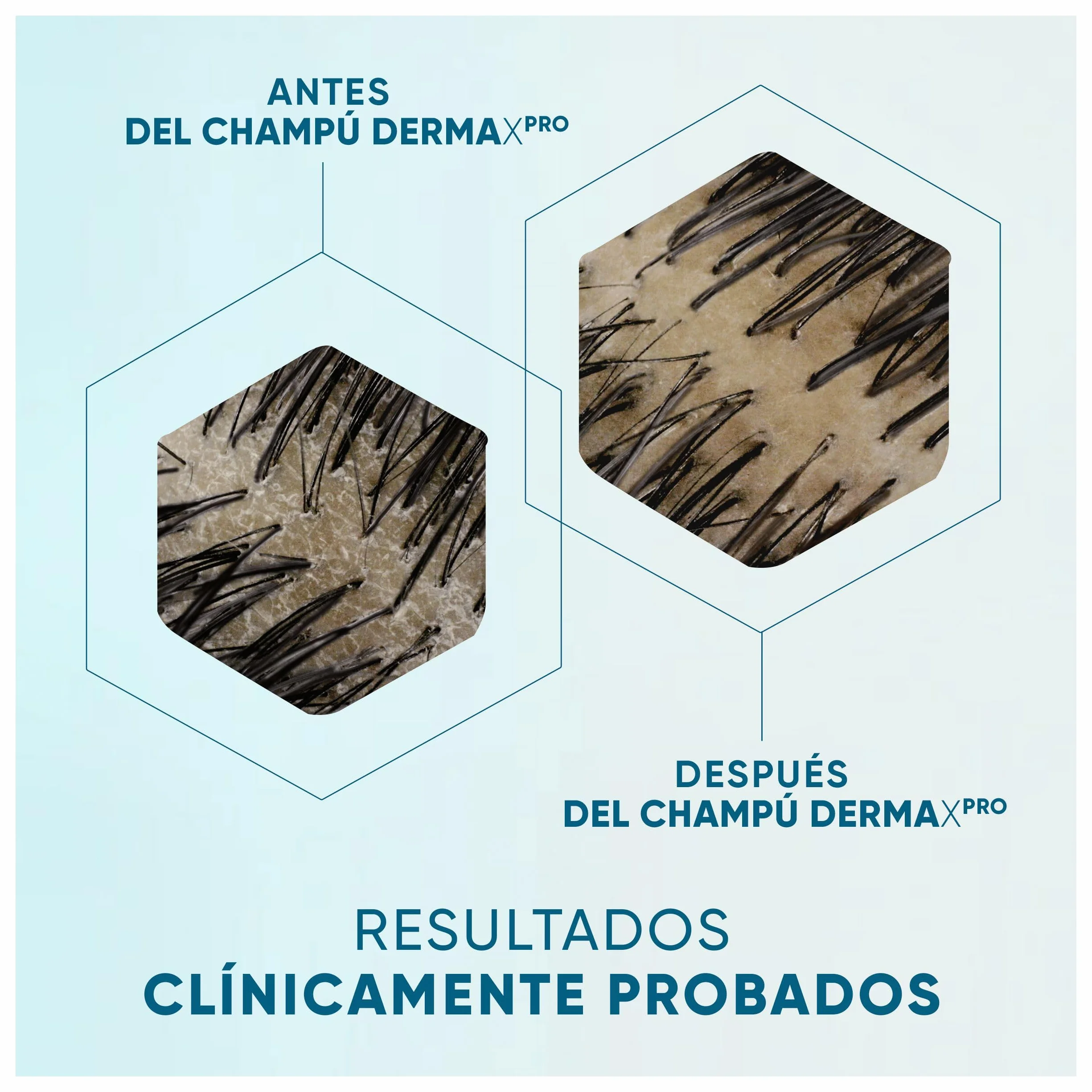 H&S DermaXPro Hidratante Champú Anticaspa 300ml + Acondicionador 220ml + Tratamiento 145ml