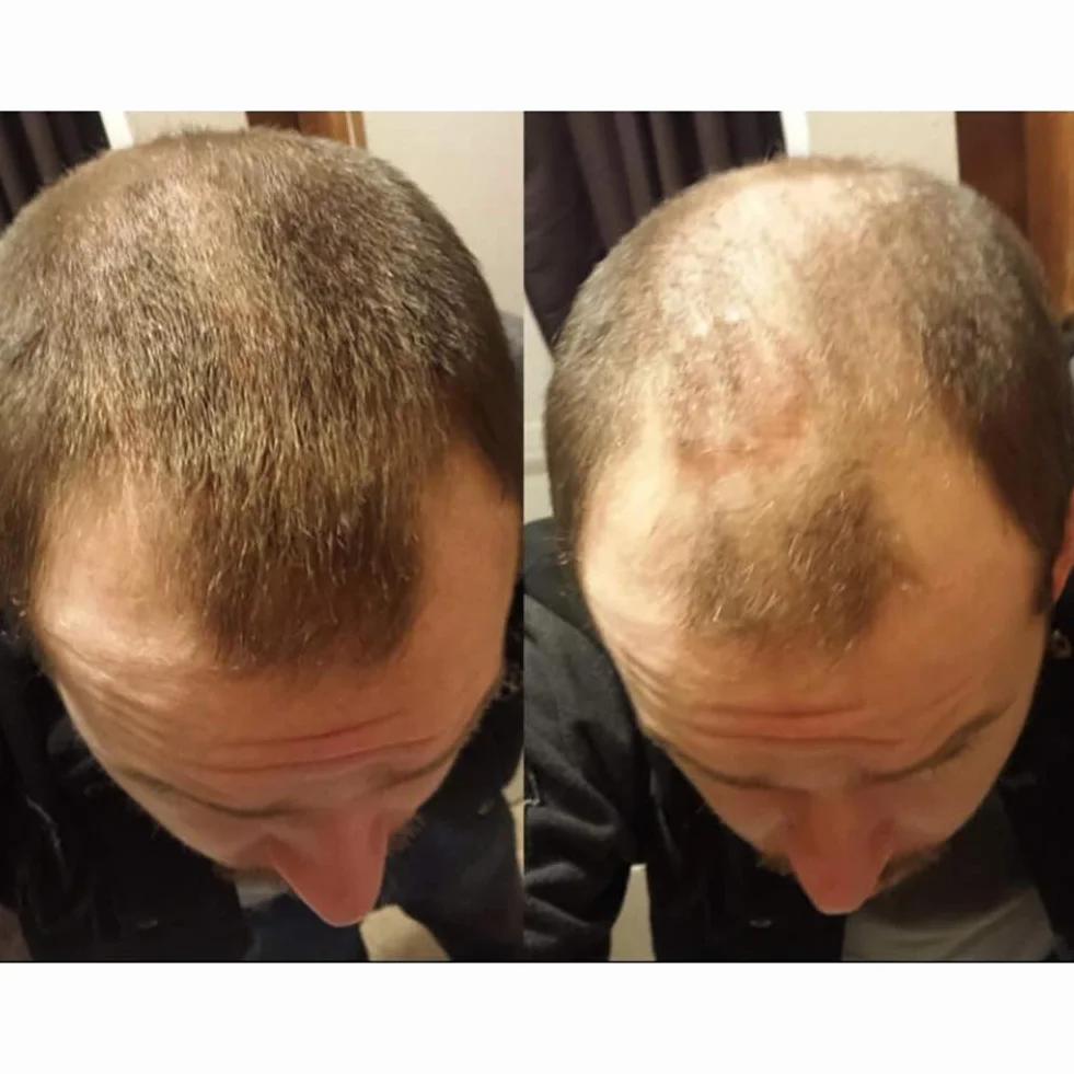 Fibras de Cabello Naturales para Cabello Fino y Escaso, Efecto Inmediato (Marron oscuro)